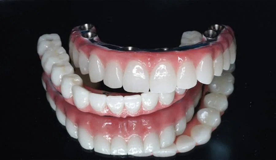 All-on-4 full-arch implant restorations