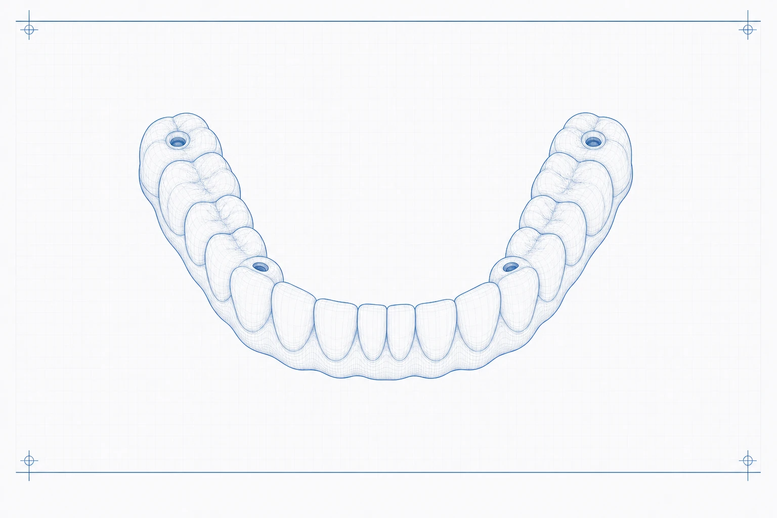 Screw-retained zirconia bridge · occlusal/three-quarter