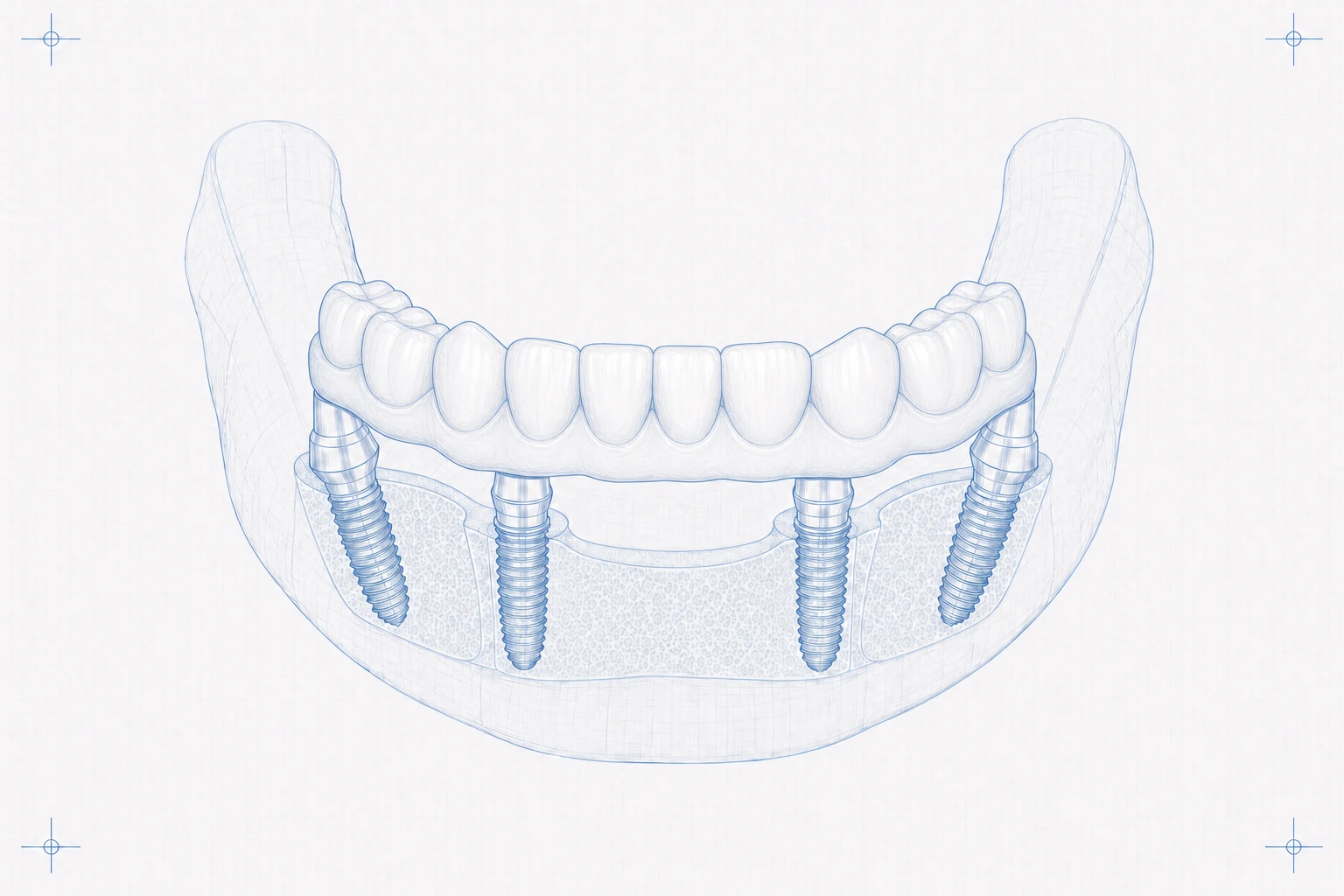 Bridge seated on multi-unit abutments