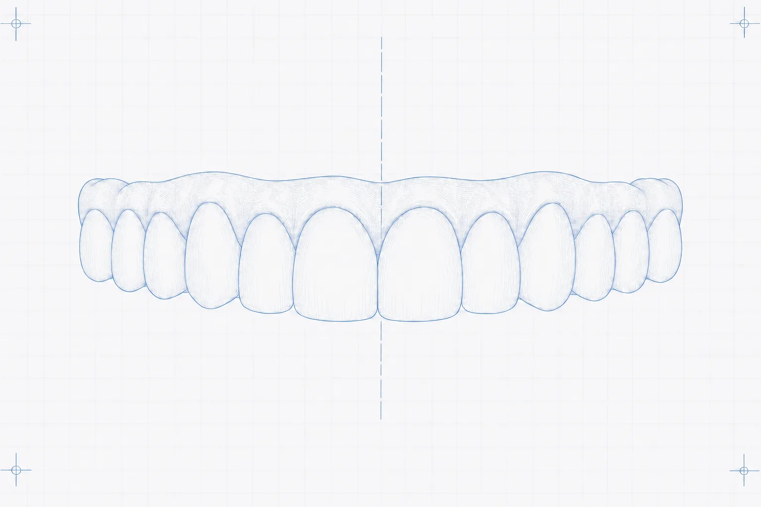 Maxillary zirconia full-arch bridge · labial view